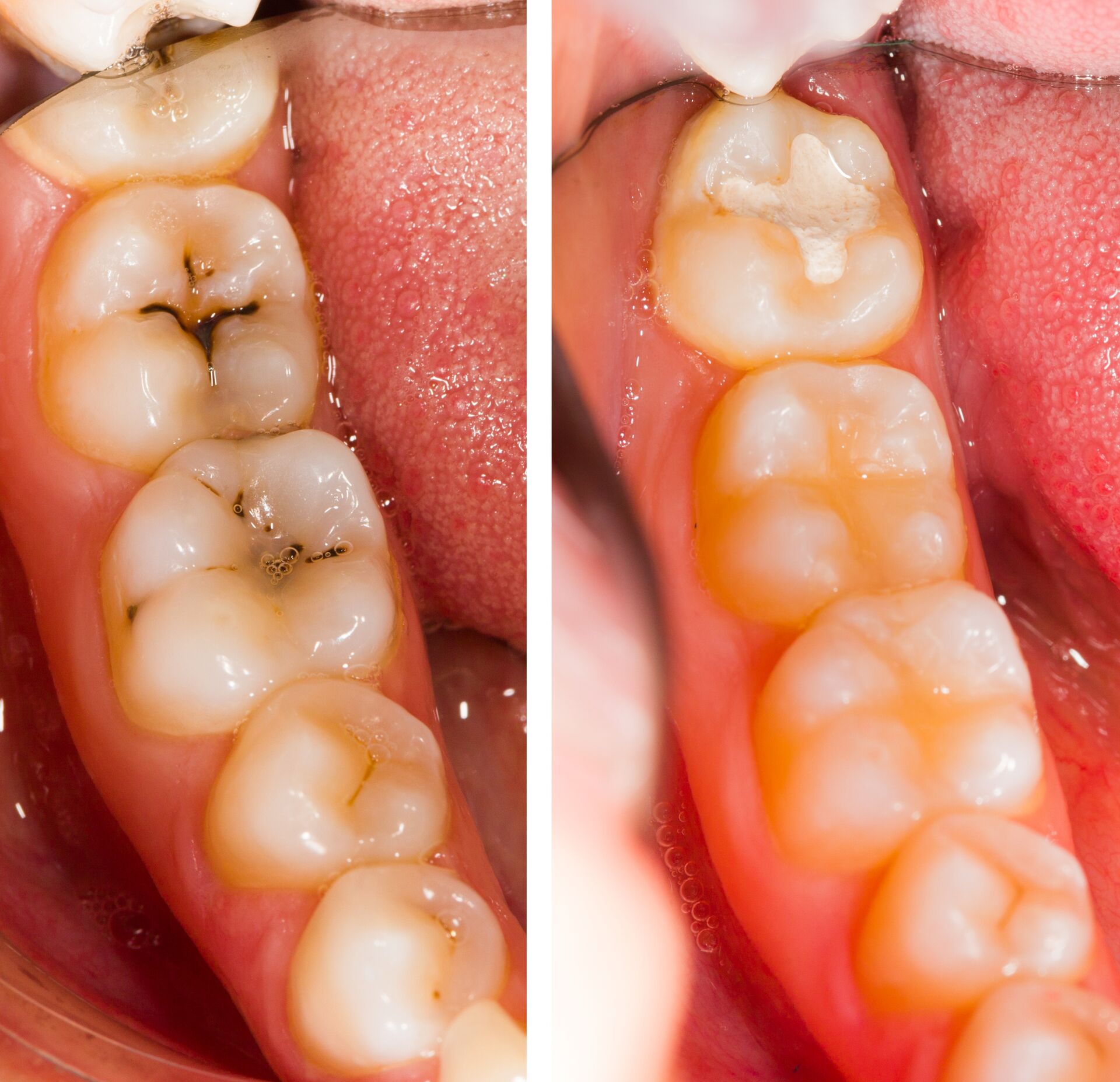 Zahnfüllungen und Inlays